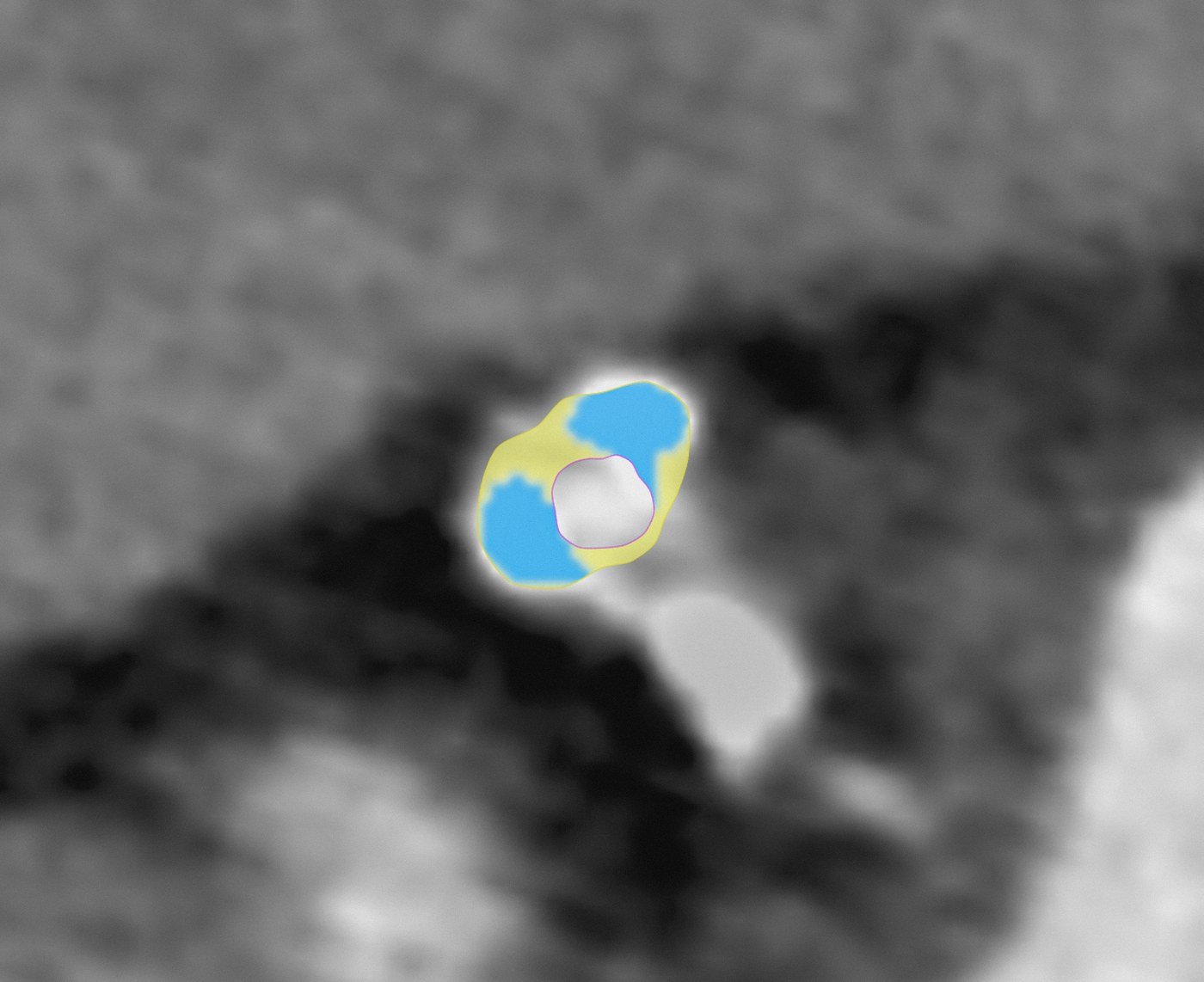 Cleerly heart scan cross-section of a coronary artery showing calcified plaque in white, non-calcified plaque in blue, and low-density plaque in yellow, with the vessel lumen outlined in magenta