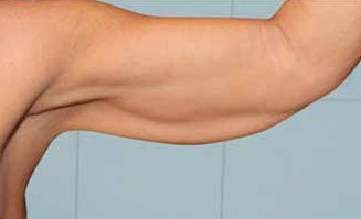 Treated area: arms, follow-up after the second session