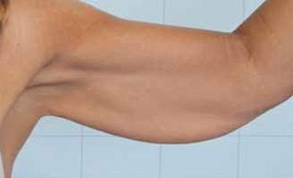 Treated area: arms, before treatment