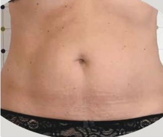 Treated area: abdomen, 60 days after treatment