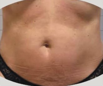 Treated area: abdomen, before